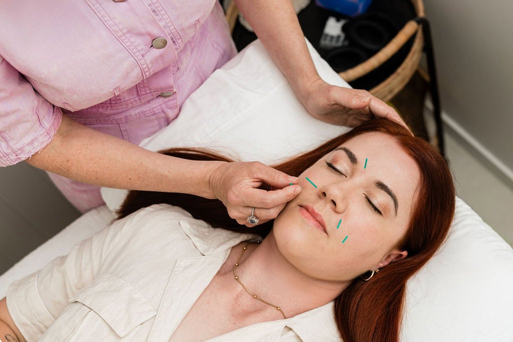 woman receiving facial acupuncture