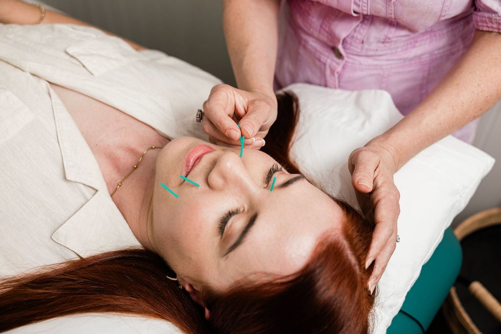 woman receiving facial acupuncture